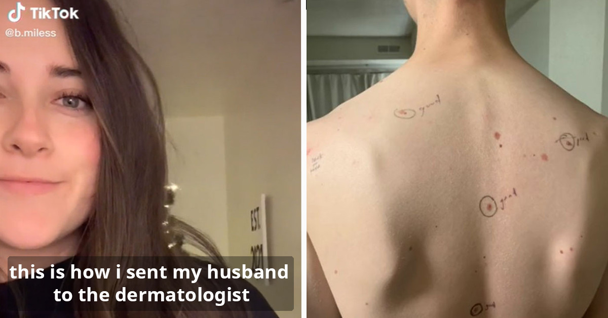 Concerned Wife Circles All The Moles On Her Husband's Body Before He Goes To The Dermatologist