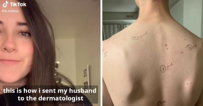 Concerned Wife Circles All The Moles On Her Husband's Body Before He Goes To The Dermatologist