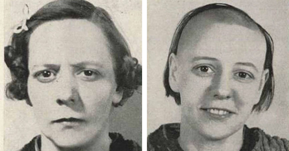 Disturbing Before and After Photos of Lobotomy Patients Will Leave You Concerned About How the Past Handled Mental Health