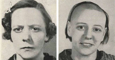 Disturbing Before and After Photos of Lobotomy Patients Will Leave You Concerned About How the Past Handled Mental Health