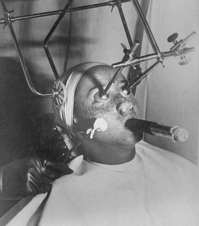 35. "Freezing Off Freckles Procedure In 1930s"