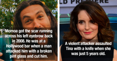 Celebrities With Very Visible Scars Explain The Reason Why They Have Them