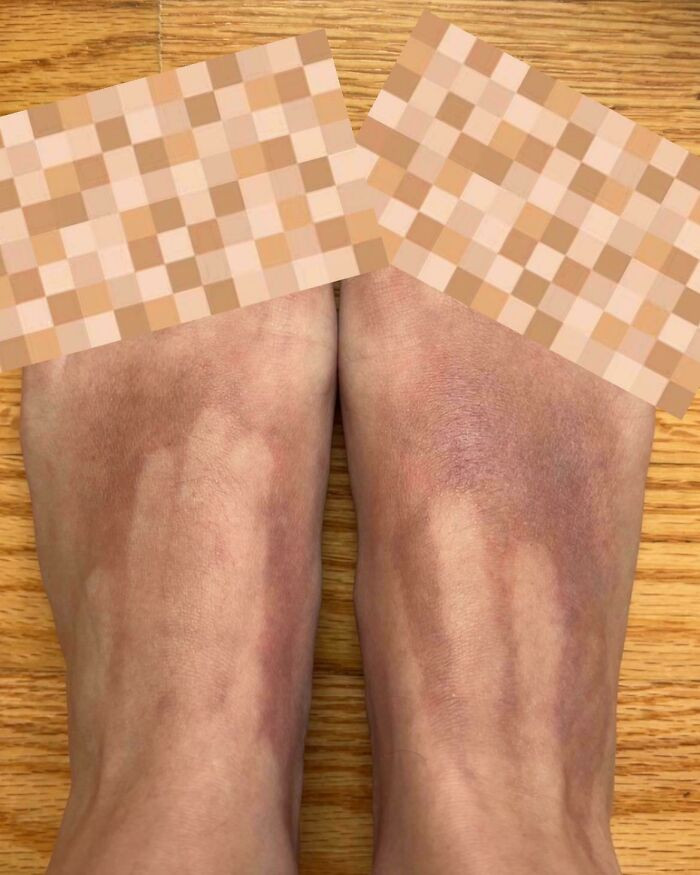 "Didn’t Completely Cover My Feet In Sunscreen. Got A Nasty Burn. You Can See Exactly Where My Fingers Stopped"