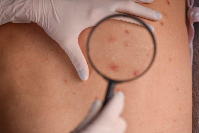 Close-up of toenail showing suspicious dark band linked to melanoma warning
