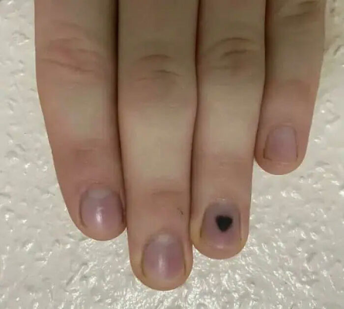 "Blood Blister Shaped Like A Heart"