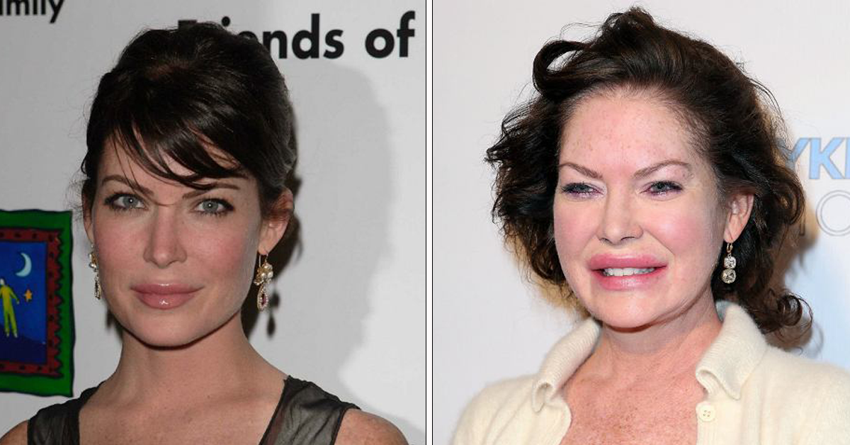 Top 15 Celebrities With Terrible Plastic Surgery