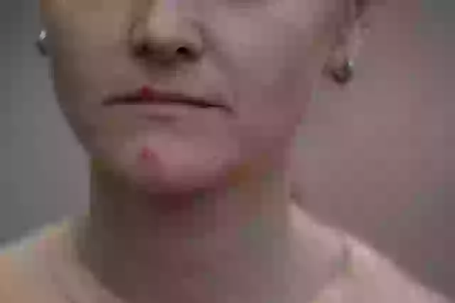 Beards can carry bacteria that enter skin breaks and cause impetigo.