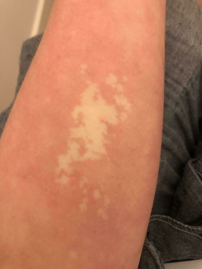"I Got Stung By A Jellyfish 20 Years Ago That Affected The Cells In My Skin, Meaning It Can't Change Color Due To Temperature"