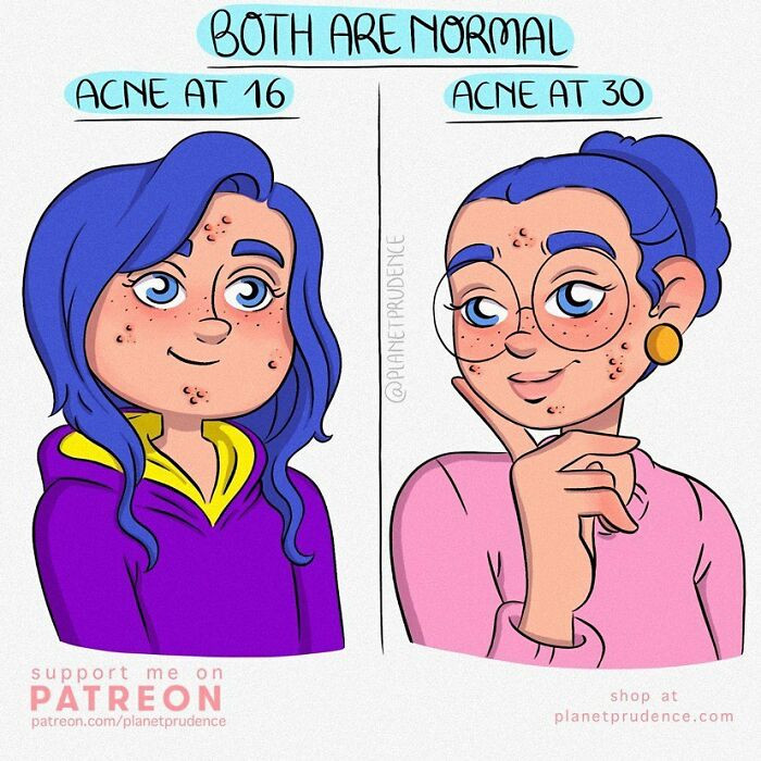 26. Having Acne at Both Ages Is Totally Normal