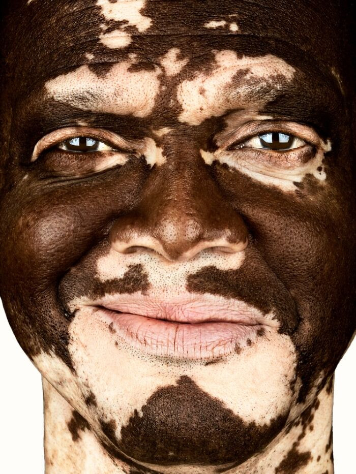 “Lle Thomas” - Vitiligo