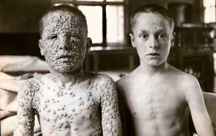 31. These Two Boys Had Been Exposed To The Same Smallpox Source. One Had Been Vaccinated, The Other Hadn’t
