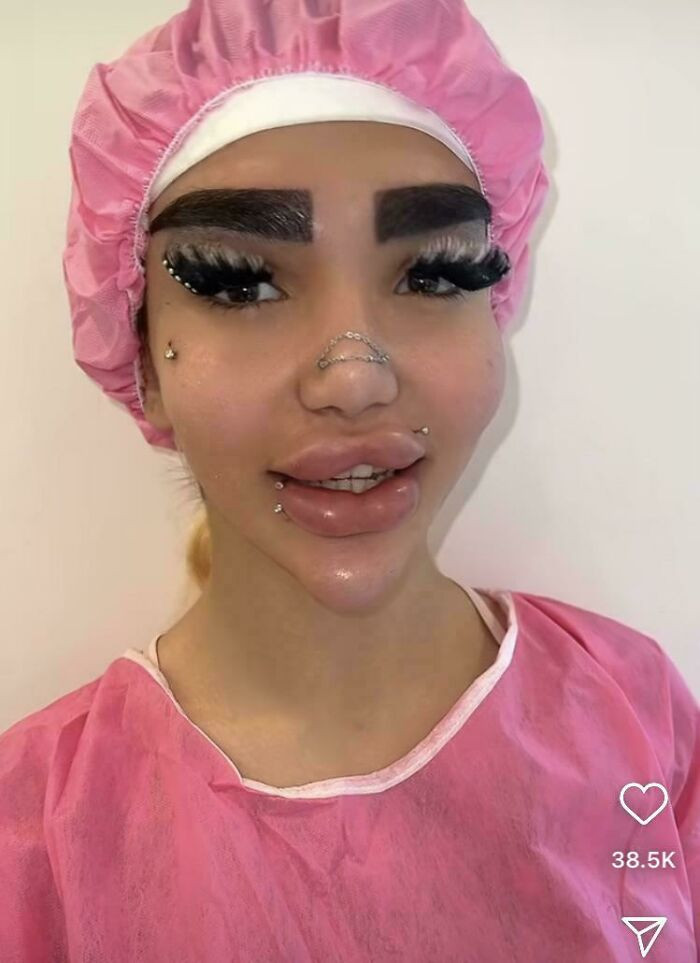 "On An Instagram Page For A Clinic That Does Eyebrow Implants"