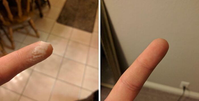 "My Body Made Me A New Fingertip In 30 Days"