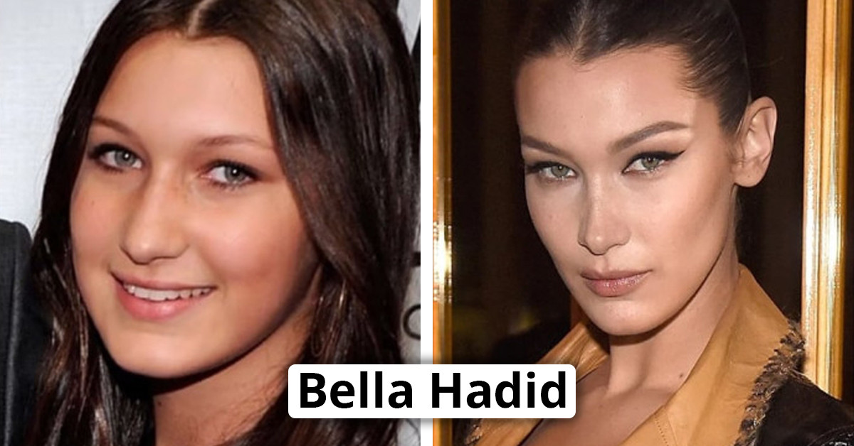 40 Celebrities Regret Getting Cosmetic Procedures And Want You To See The Ugly Side Of Beauty Treatments