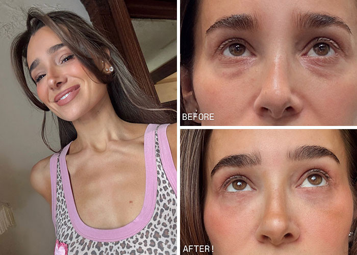 Danielle Bernstein - Lower blepharoplasty