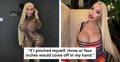 Human Barbie Emerges Bandaged And Bold After Fifth Facelift