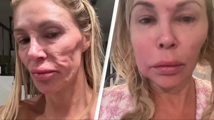 Brandi Glanville speaking publicly about facial parasite diagnosis and personal losses