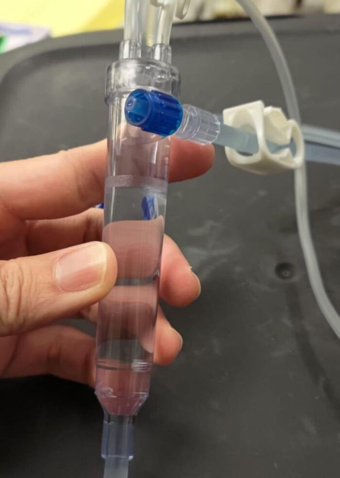 "Dialysis Venous Chamber Missing A Filter That Prevents Blood Clots From Entering The Patient’s Blood Stream, Causing Stroke Or Heart Attack"
