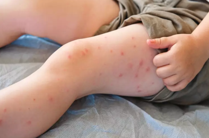 Passengers at an American airport terminal, highlighting measles resurgence and vaccination