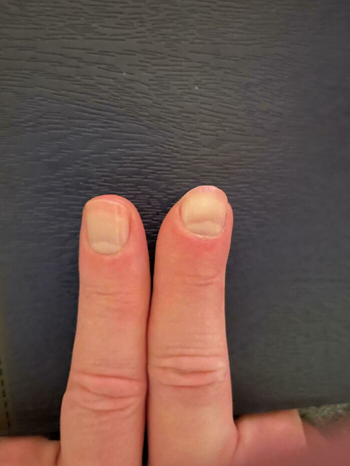 "My Finger That Was Nearly Amputated And Then Replaced With A Graft. The Nail Grew Back And I Have A Partial Fingerprint"