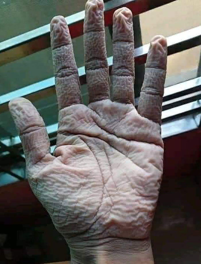 48. This Is The Hand Of A Doctor After Removing His Medical Precautionary Suit And Gloves After 10 Hours Of Duty