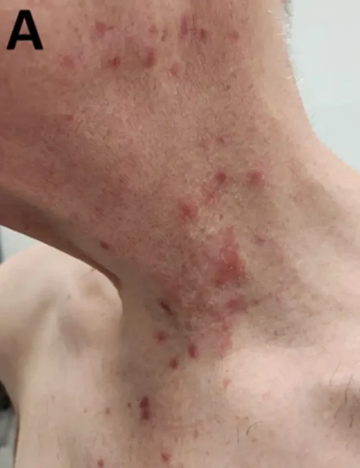The Crusty Skin Infection That Jumps from Animals to People
