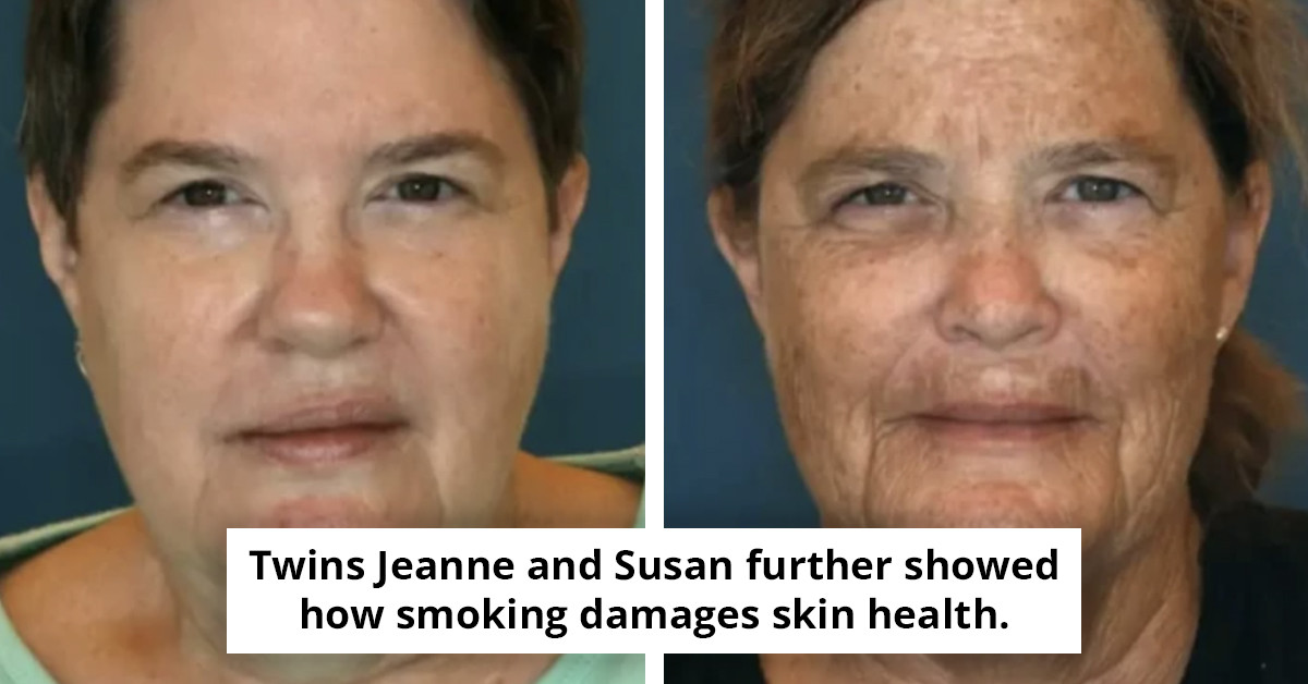 Identical twins share surprising transformations in their appearances due to one smoking while the other abstained.