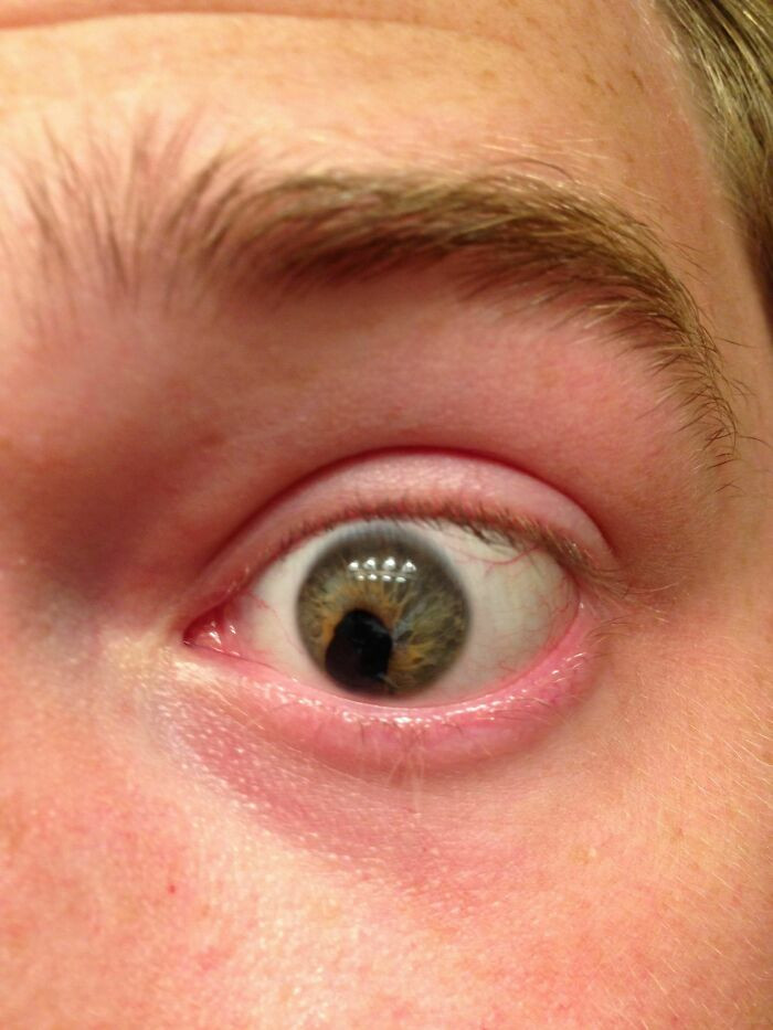 "I Was Stabbed In The Eye With A Hanger 11 Years Ago"