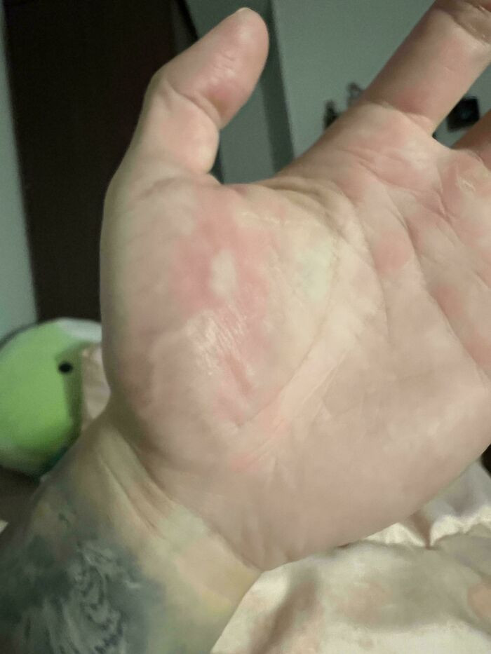 "Mosquito Bite Traveling Down My"