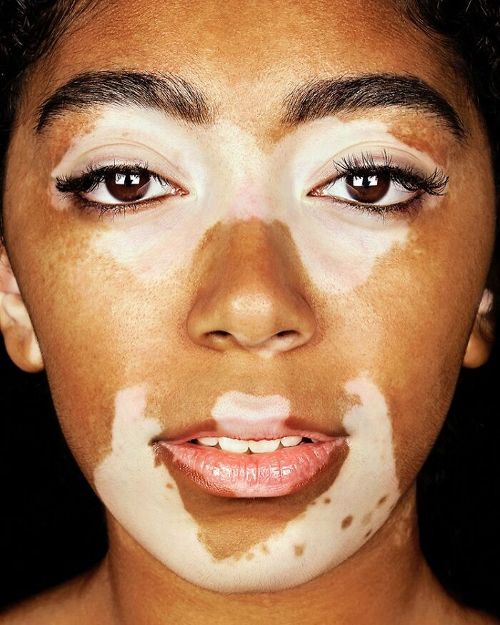 “Leonie Timothy” - Vitiligo