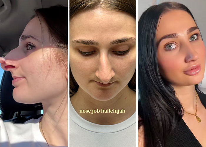 Devyn Aiken - Rhinoplasty