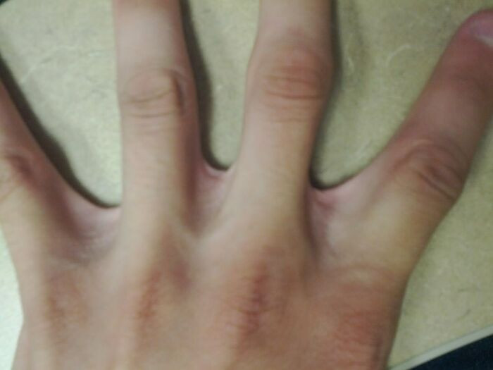 "My Fingers Have Extra Webbing"