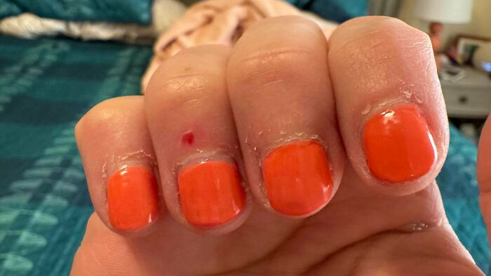 "Went To Get A Manicure At A Well-Reviewed Place After Having My Nails Damaged At Another Salon. This Is How My Fingers Look A Day Later"