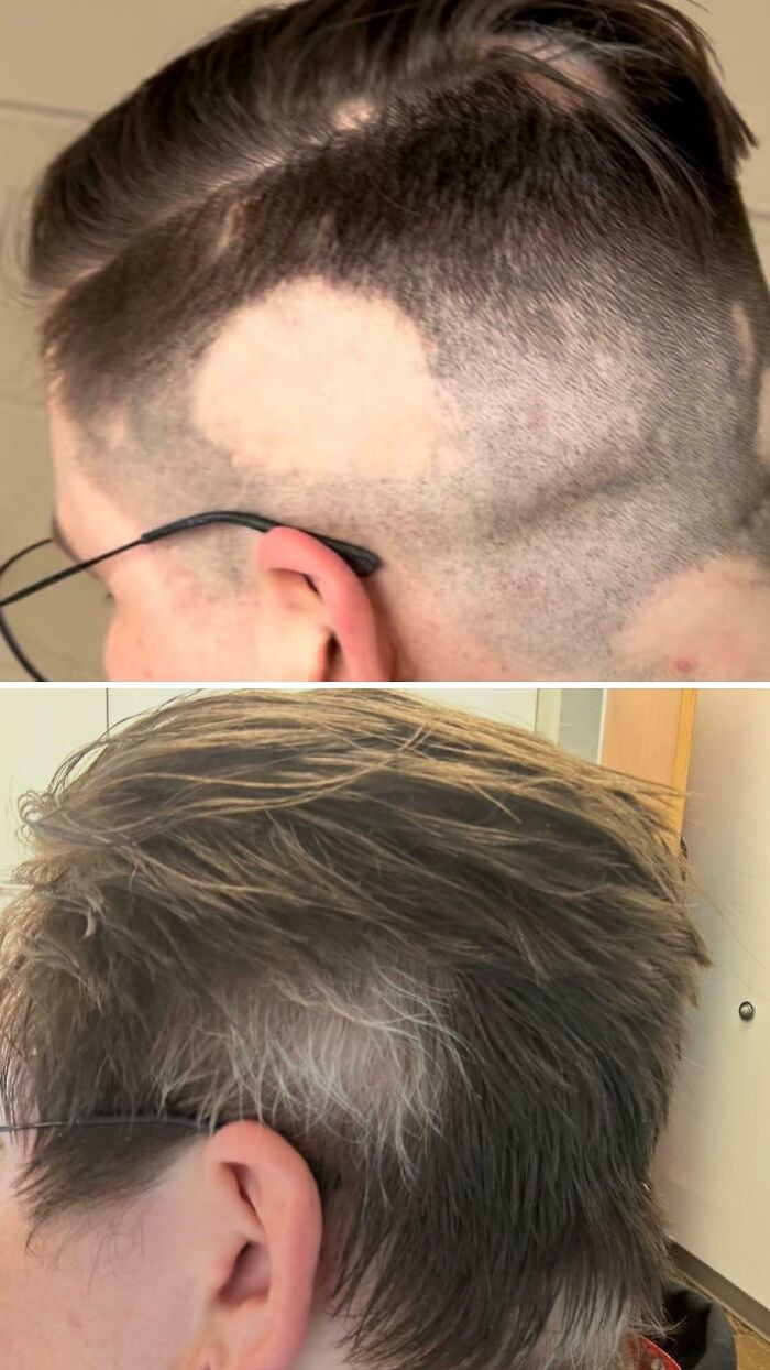 "I Lost My Hair In Spots And It Grew Back White"