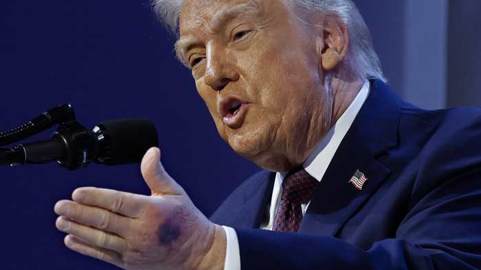 White House press briefing, officials discuss aspirin use and Trump's minor hand injury
