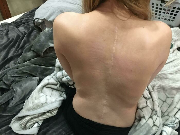 "My Back/Scars After Having 2 Back Surgeries For Scoliosis"