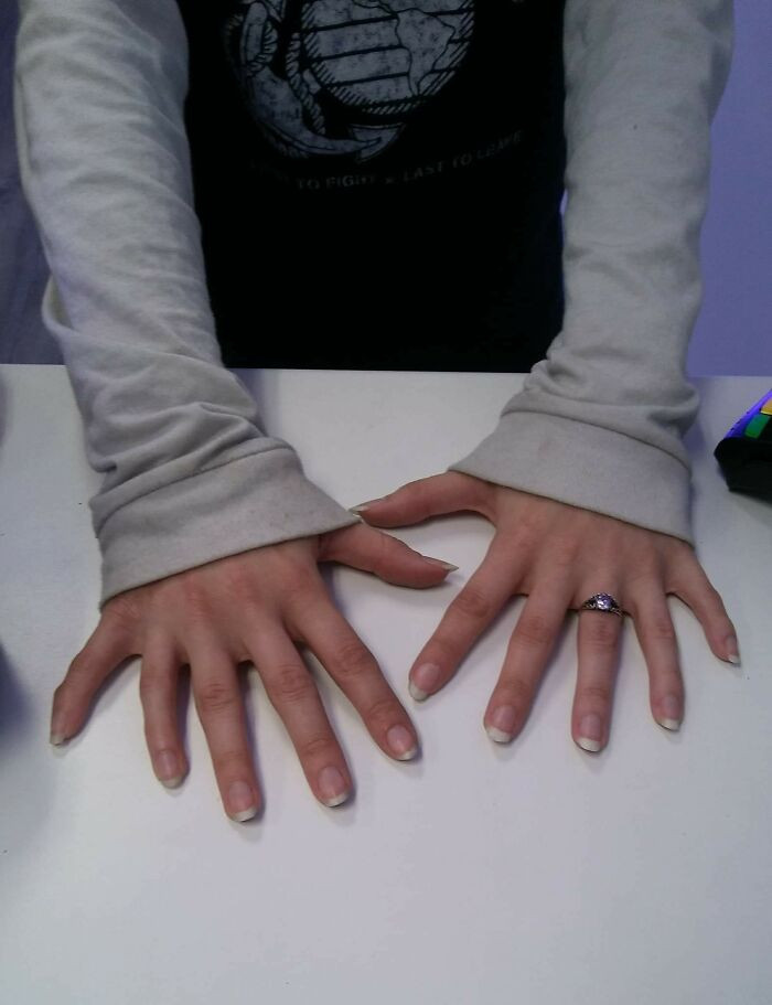 "A Customer Came In And Let Me Take A Picture Of Her Hands That Had 6 Fingers On Each"