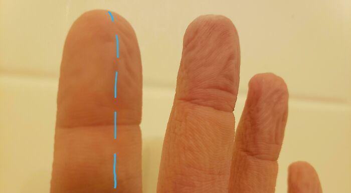 "I Severed A Nerve In My Index Finger... Half Of My Finger Can No Longer Prune"