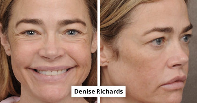 15 Celebrities And Influencers Who Proudly Shared Their Plastic Surgery Journey