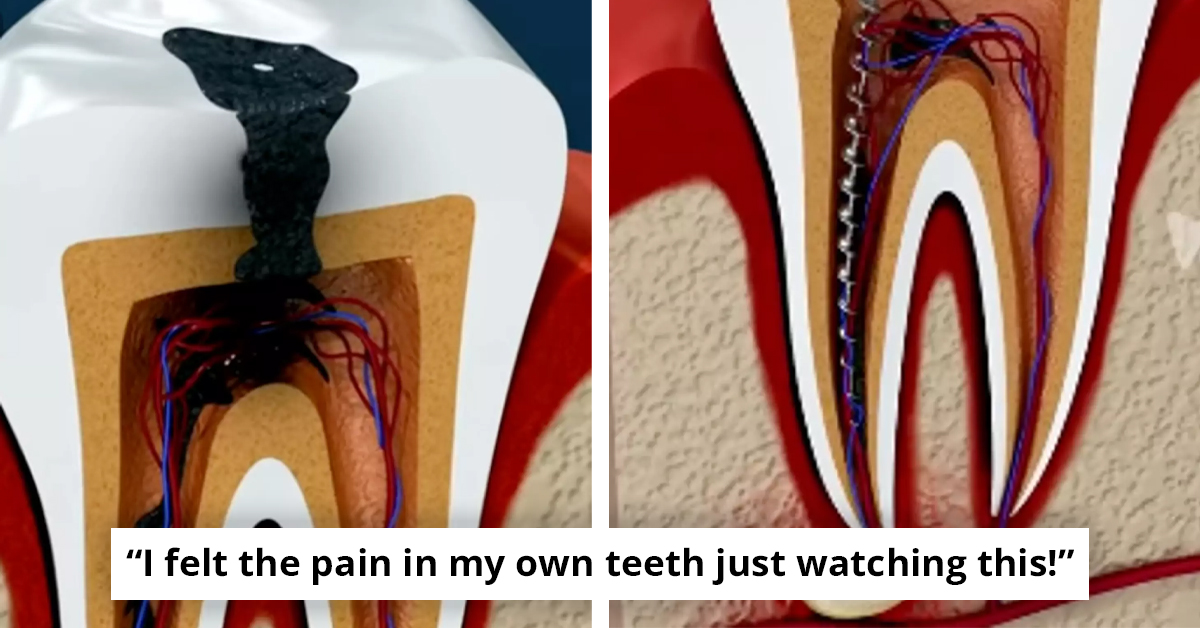 Why This Root Canal Simulation Has Viewers Cringing And Rethinking Dental Hygiene