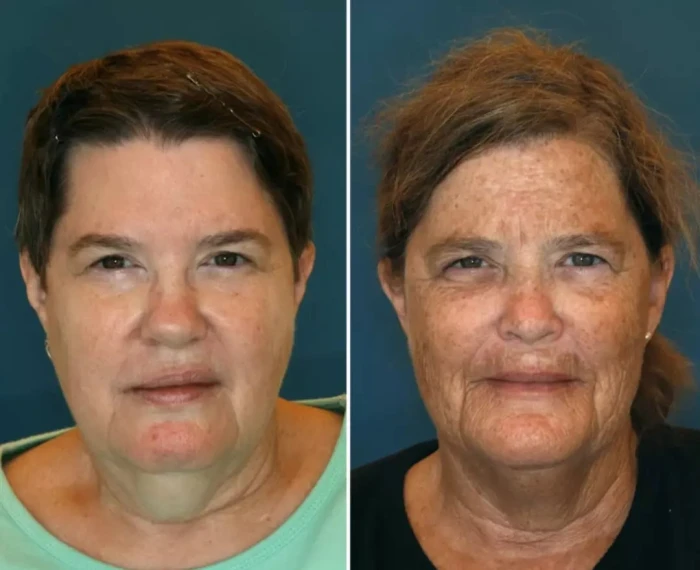 Identical twins with contrasting facial skin aging, smoker versus non-smoker.