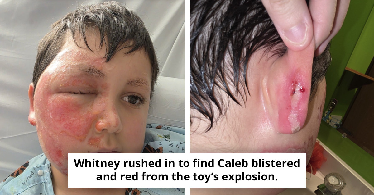 9-Year-Old Boy Suffers Severe Facial Burns Amid Disturbing Social Media Trend