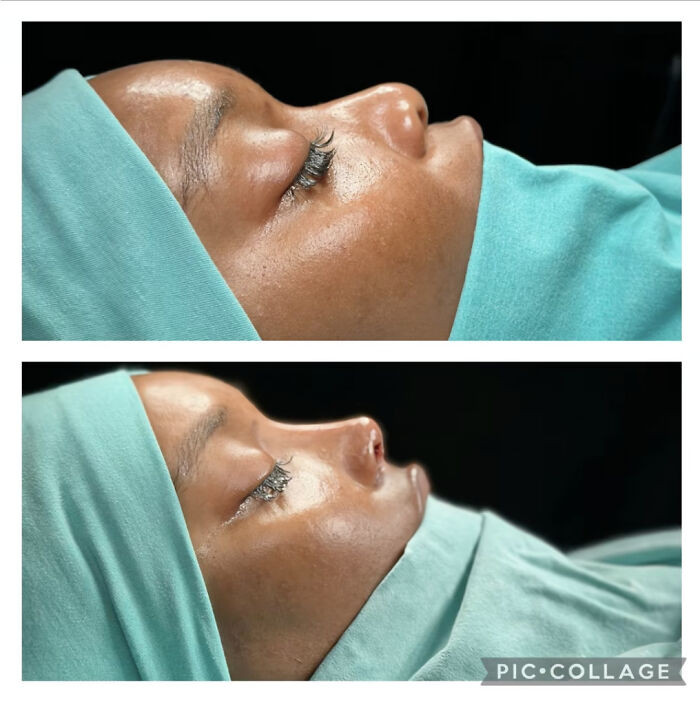 1. The cutest nose job.