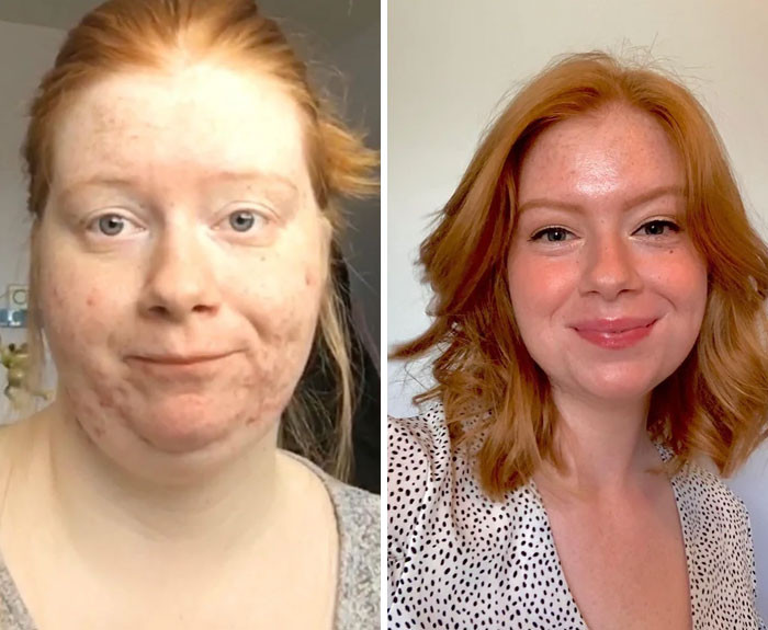 "F/22/5'5 [190 > 129 = -61lbs] I Used To Be Afraid Of Having Short Hair Because Of The Weight In My Face. Today, I Said Goodbye To The Old Me And Embraced My New Life!"