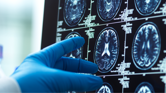 Person reviewing bank statements, showing financial distress linked to early cognitive decline