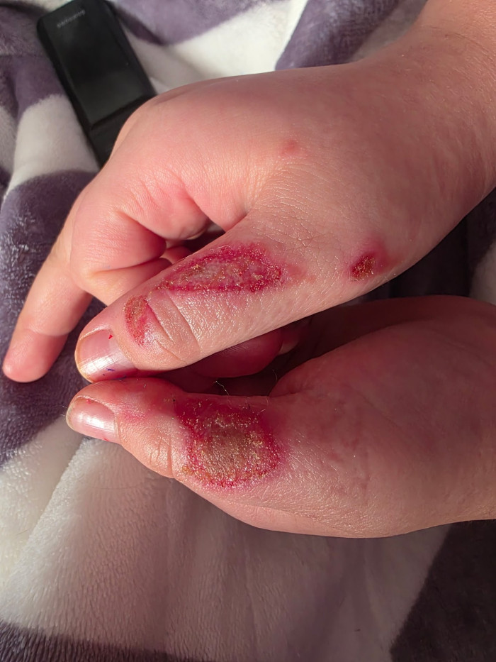Child treated in urgent care for burns linked to dangerous microwaving trend