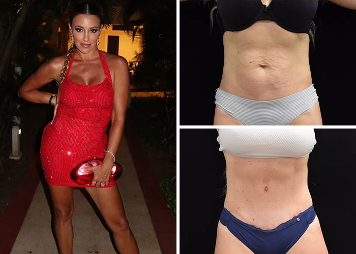 Danielle Cabral - Tummy tuck