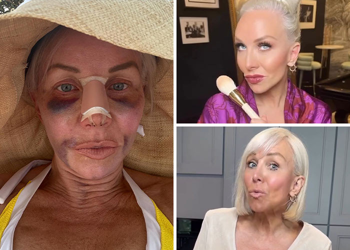 Margaret Josephs - Nose job