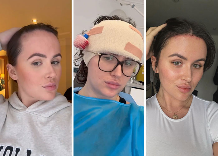 Beth Halsey - Hairline lowering surgery