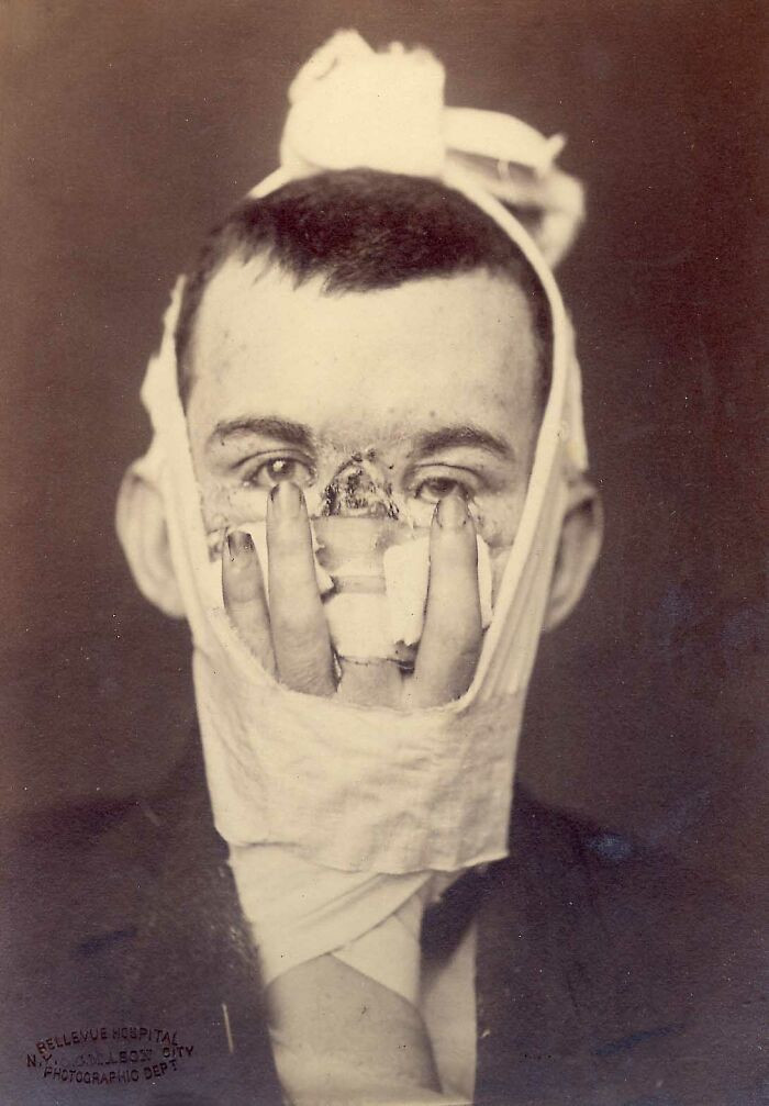 "Portrait Of A Man Who Received A Rhinoplasty After Losing His Nose In An Injury. The 'Prosthetic' Nose, In The Case, Is One Of His Fingers"